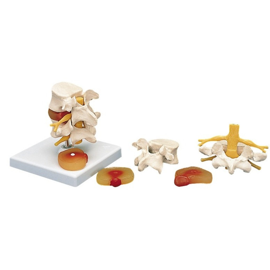 Modèle de vertèbres lombaires avec hernies discales